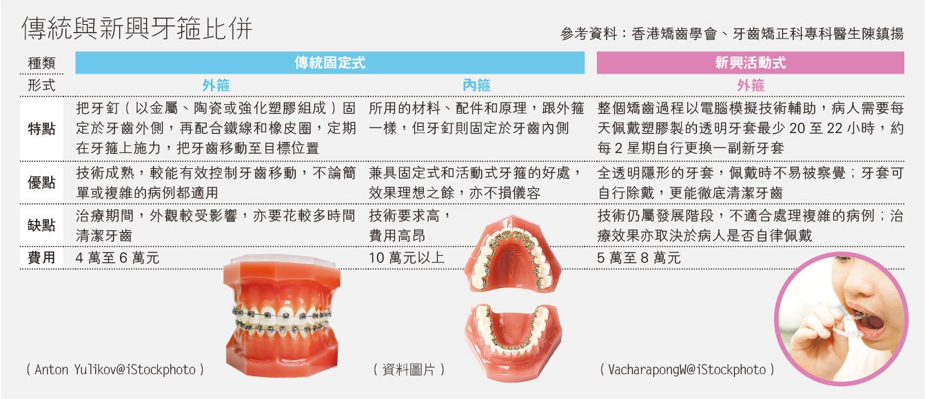 牙齒矯正：牙齒不齊整 影響咬字咀嚼 固定式vs.活動式 箍牙前看清利弊